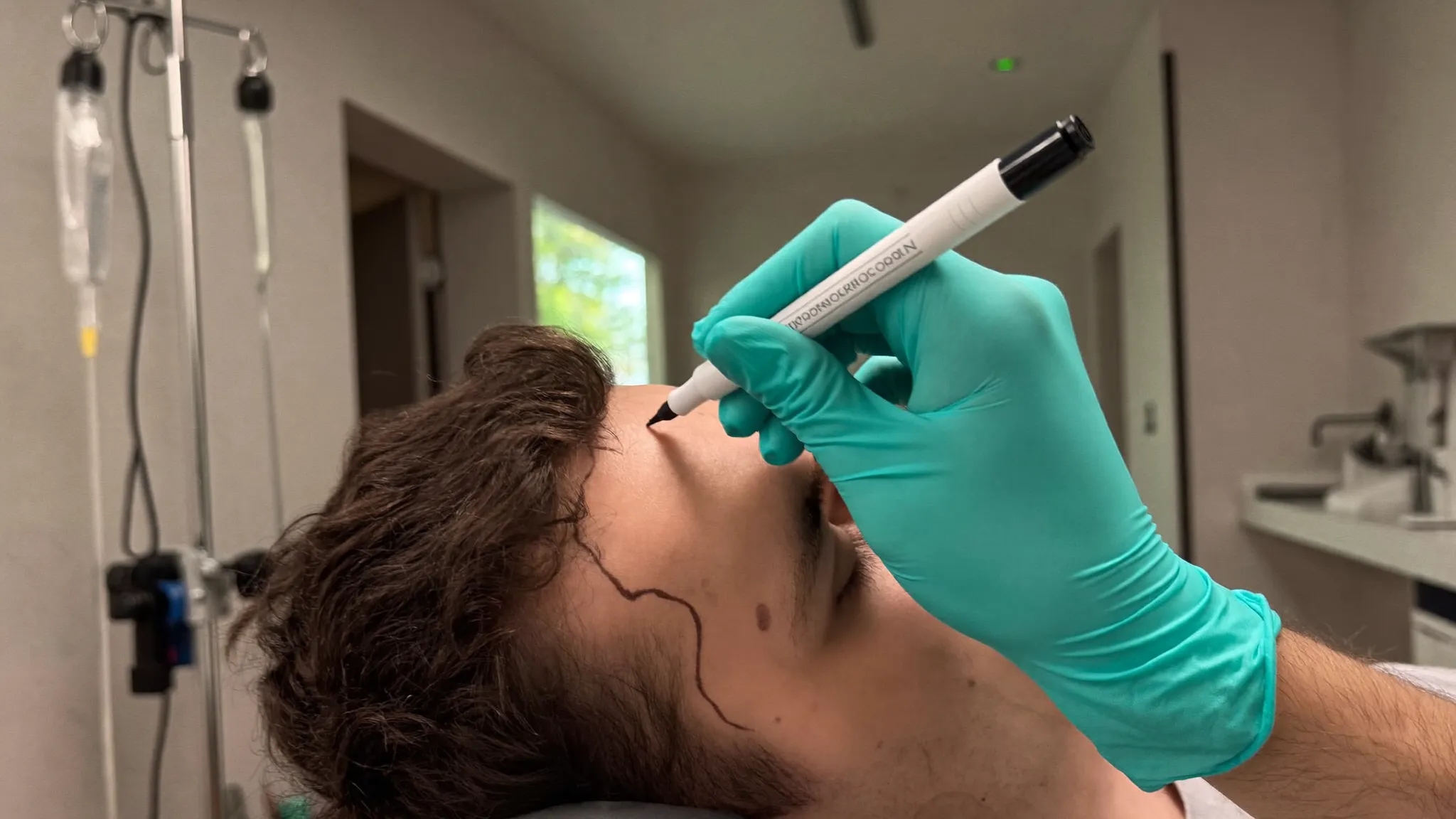 Anzeichnen der natürlichen Haarlinie vor der Transplantation