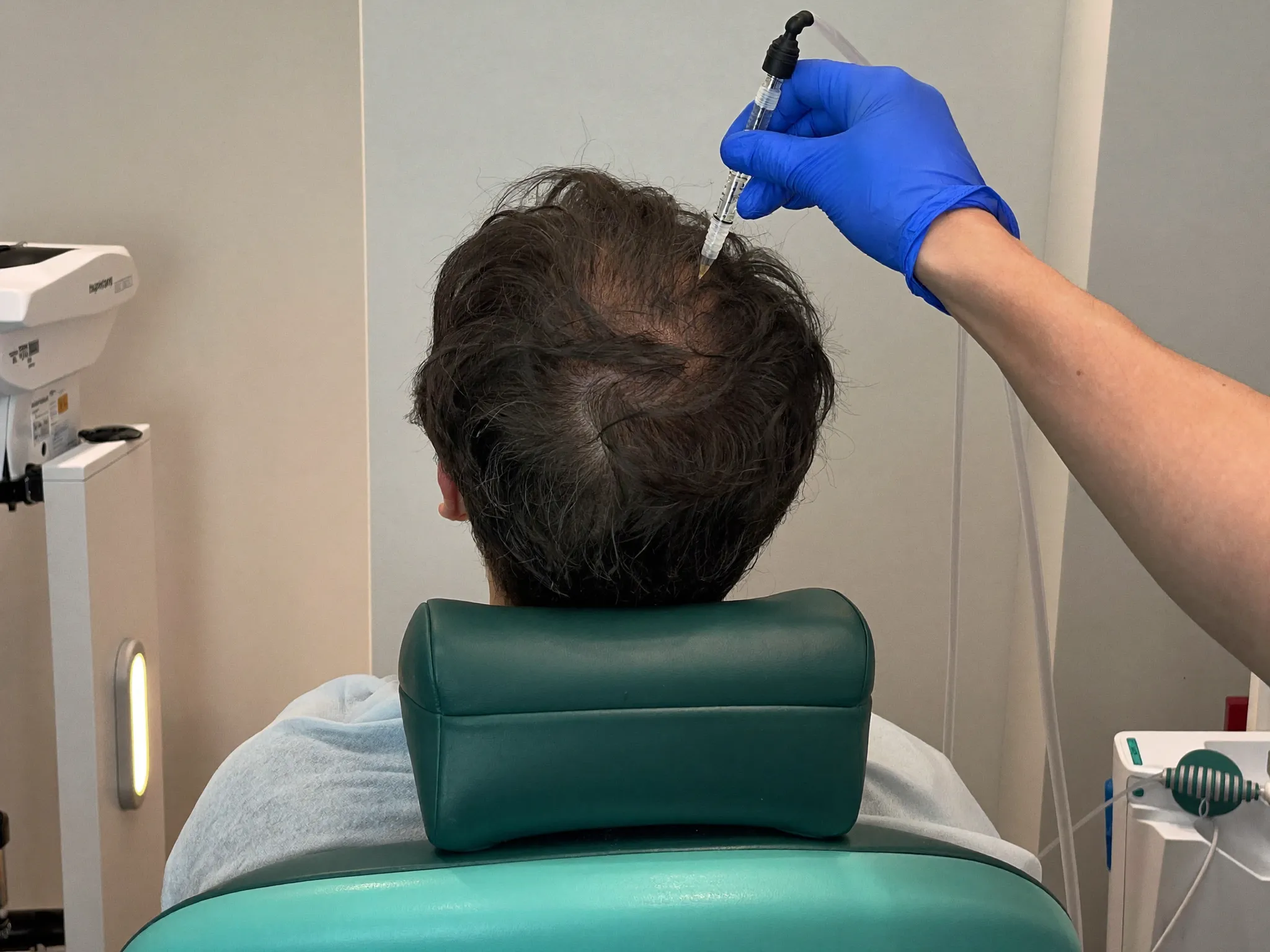 Mesotherapie der Kopfhaut mit feinen Mikroinjektionen